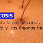 CCSS: 1 de cada 4 personas tiene una infección por hongos en la piel