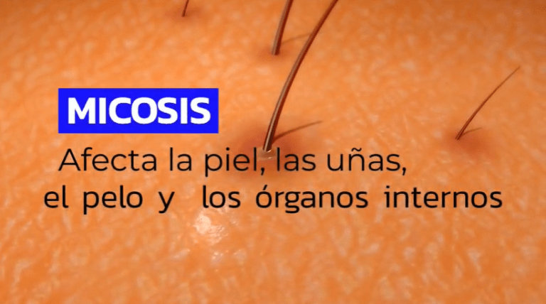 CCSS: 1 de cada 4 personas tiene una infección por hongos en la piel